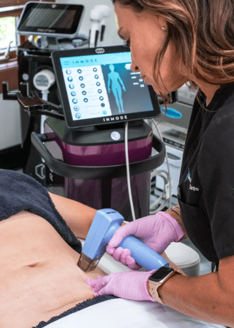 Morpheus8 Body Treatment